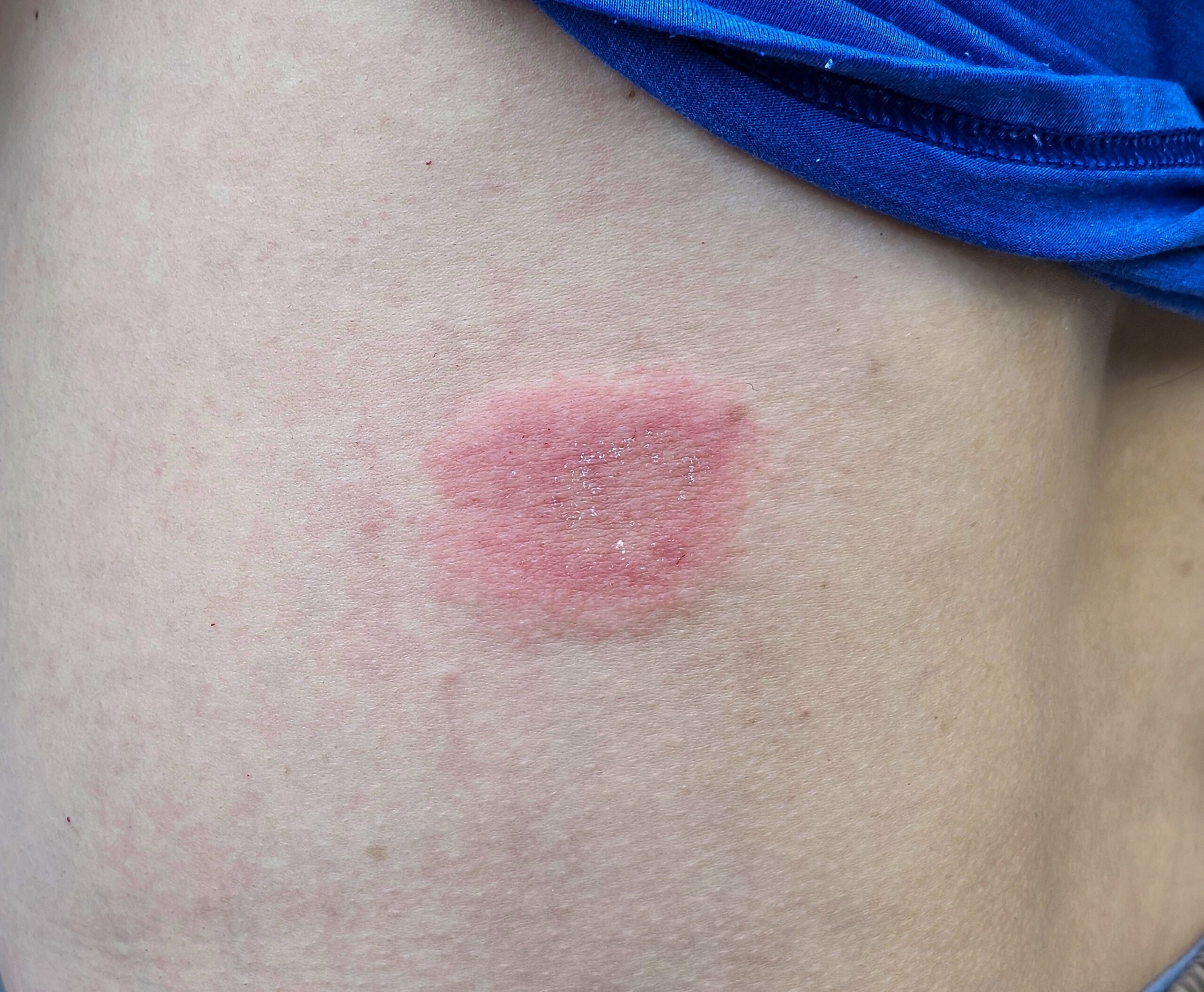 Ringworm
