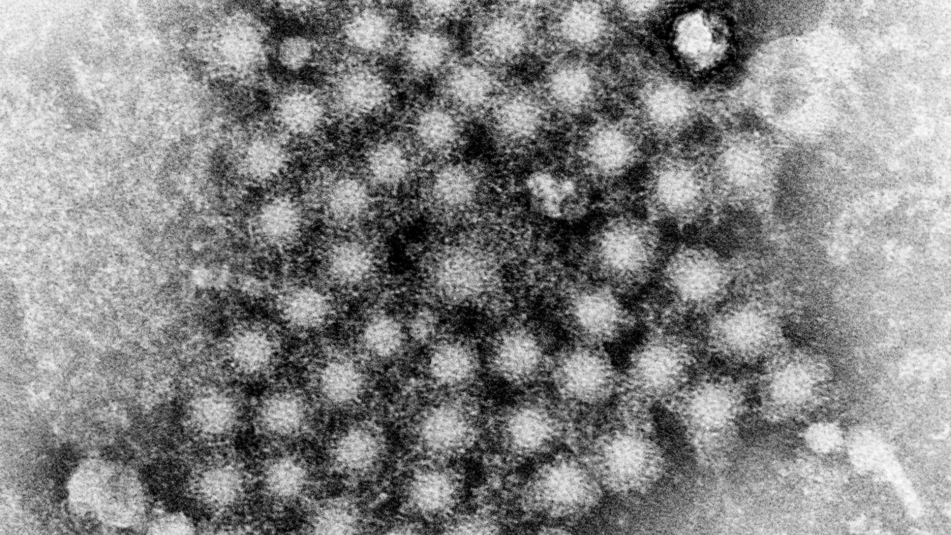 Hepatitis A
