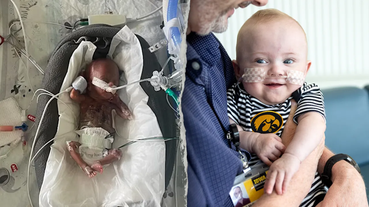 Iowa baby, born at 21 weeks, holds world record as the most premature