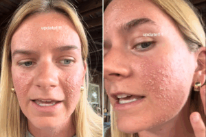 Rash on face
